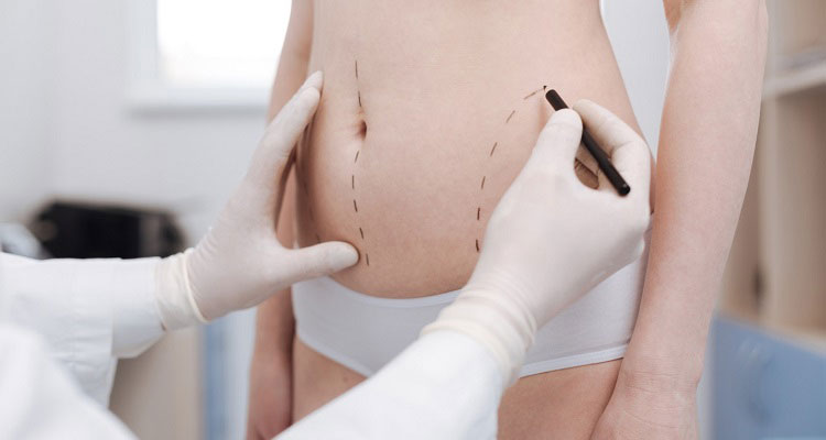 liposuction surgery