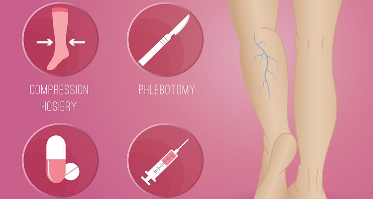 Why Are My Veins So Visible 5 Things to Know About Spider Veins
