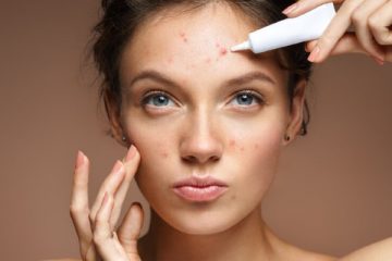 How to Prevent Acne Scars