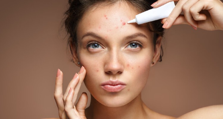 How to Prevent Acne Scars