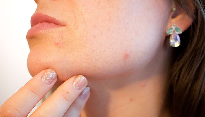 Treat Active Acne Breakouts Before Undergoing a Laser Procedure 