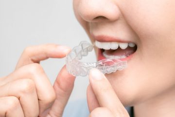 Things to know before you get Invisalign