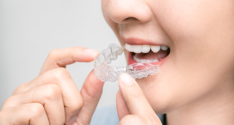 Things to know before you get Invisalign