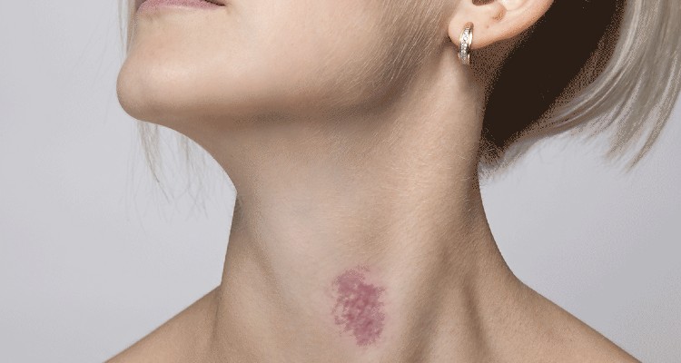 How to Get Rid of Hickies In Easy Steps!