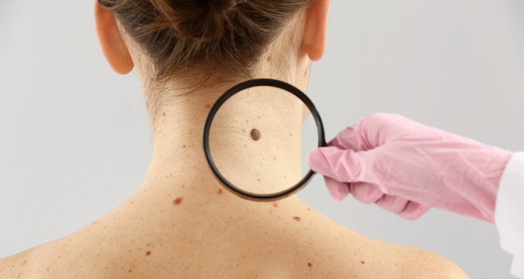 5 Signs It Might Be Time To Check Out That Mole