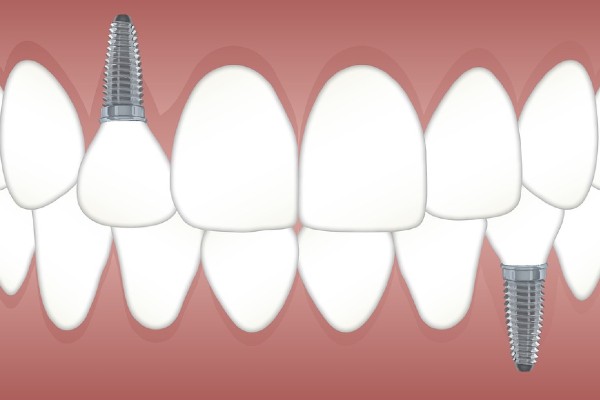 Dental Implants