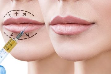 A Complete And Effective Guide On Lip Fillers