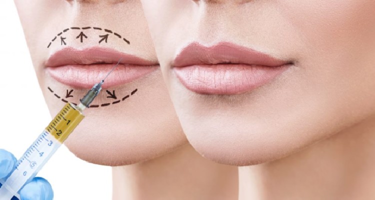 A Complete And Effective Guide On Lip Fillers