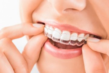 5 Reasons To Consider Clear Aligners For Your Teeth