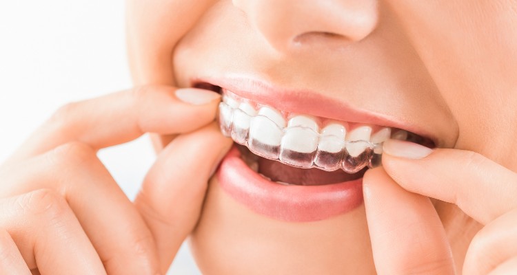5 Reasons To Consider Clear Aligners For Your Teeth