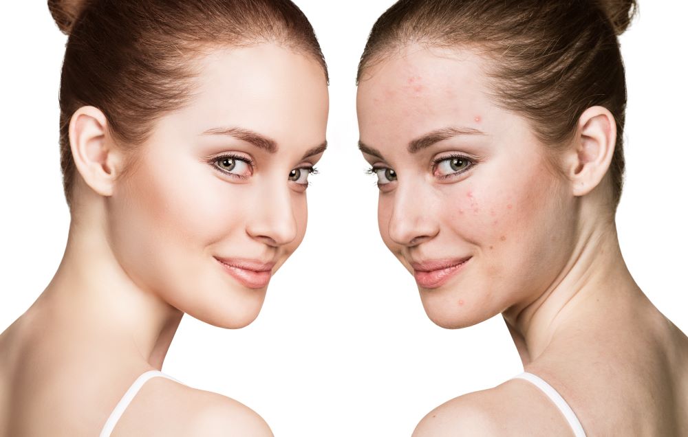 Top 6 skincare ingredients for acne prone skin