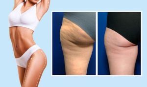 Thigh Lift Surgery –Types and Cost