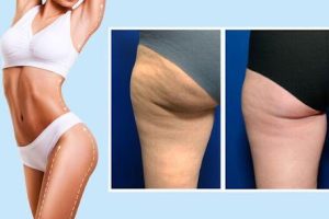 Thigh Lift Surgery –Types and Cost