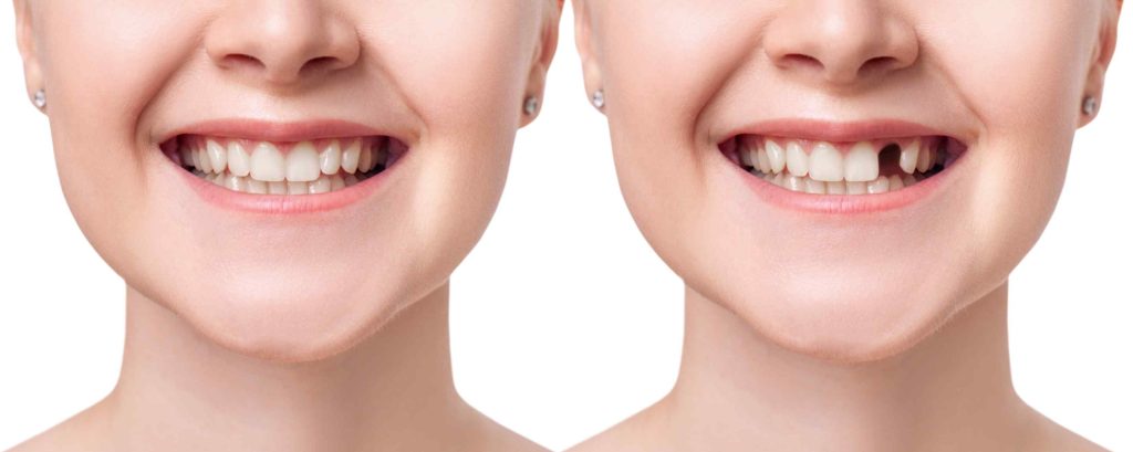 Before and after images showcasing the transformation with dental prostheses.