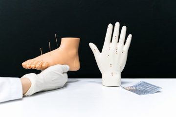 Acupuncture.