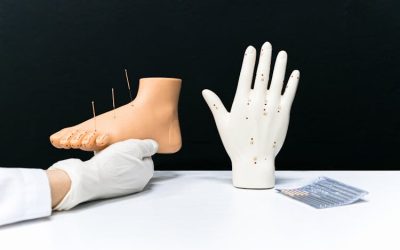 Acupuncture.