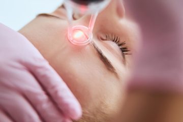Laser technology skin treatment